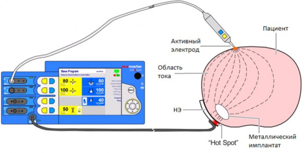 Схема протекания тока через пациента с металлическим имплантом