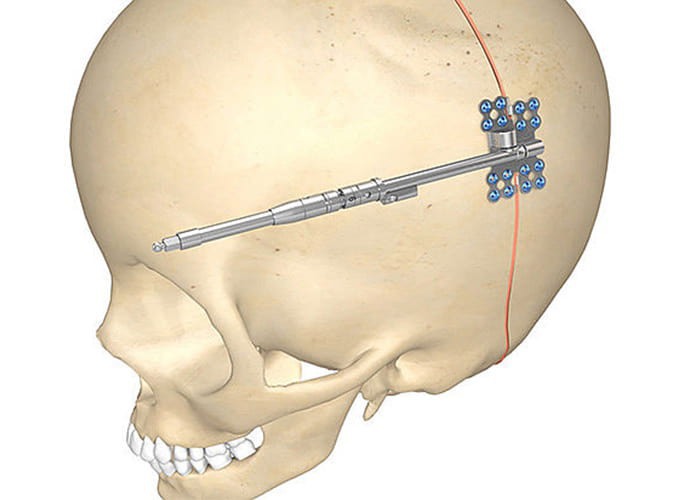 Дистракторы для заднего черепного свода от KLS Martin